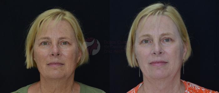 Before & After Chemical Peels Case 63 View #4 View in Dallas, TX