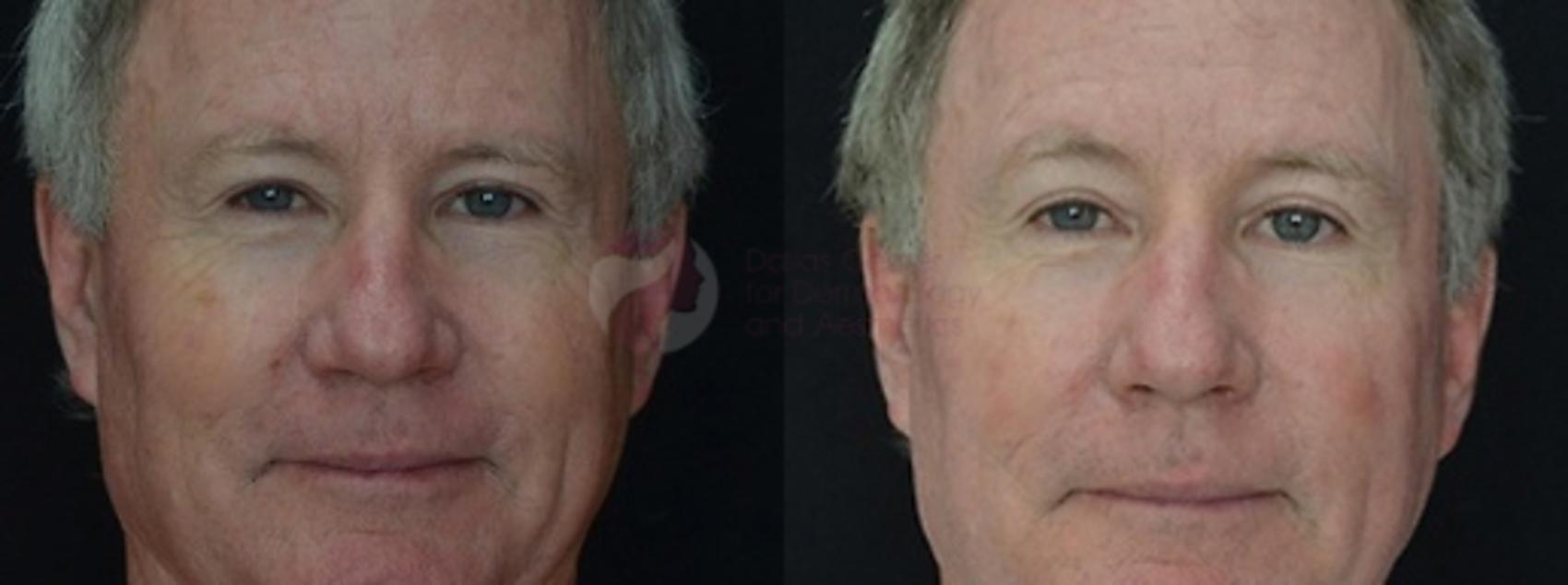 Before & After Chemical Peels Case 64 Front View in Dallas, Plano, and Frisco, TX