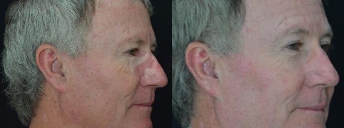 Before & After Chemical Peels Case 64 Right Side View in Dallas, TX