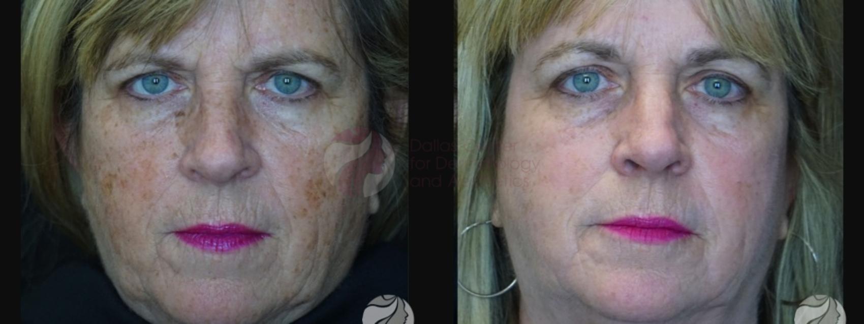Before & After Chemical Peels Case 83 Front View in Dallas, Plano, and Frisco, TX