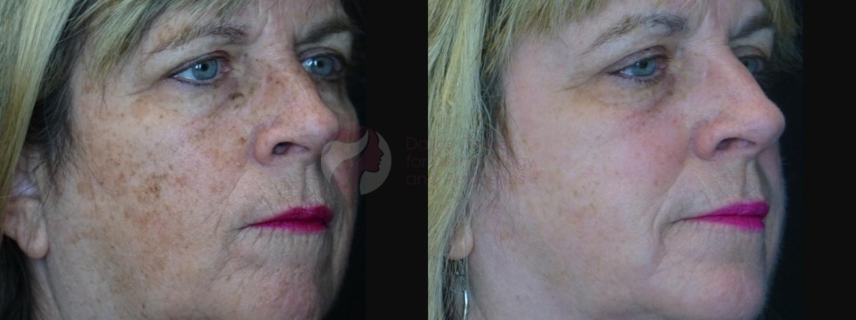 Before & After Chemical Peels Case 83 Right Oblique View in Dallas, Plano, and Frisco, TX