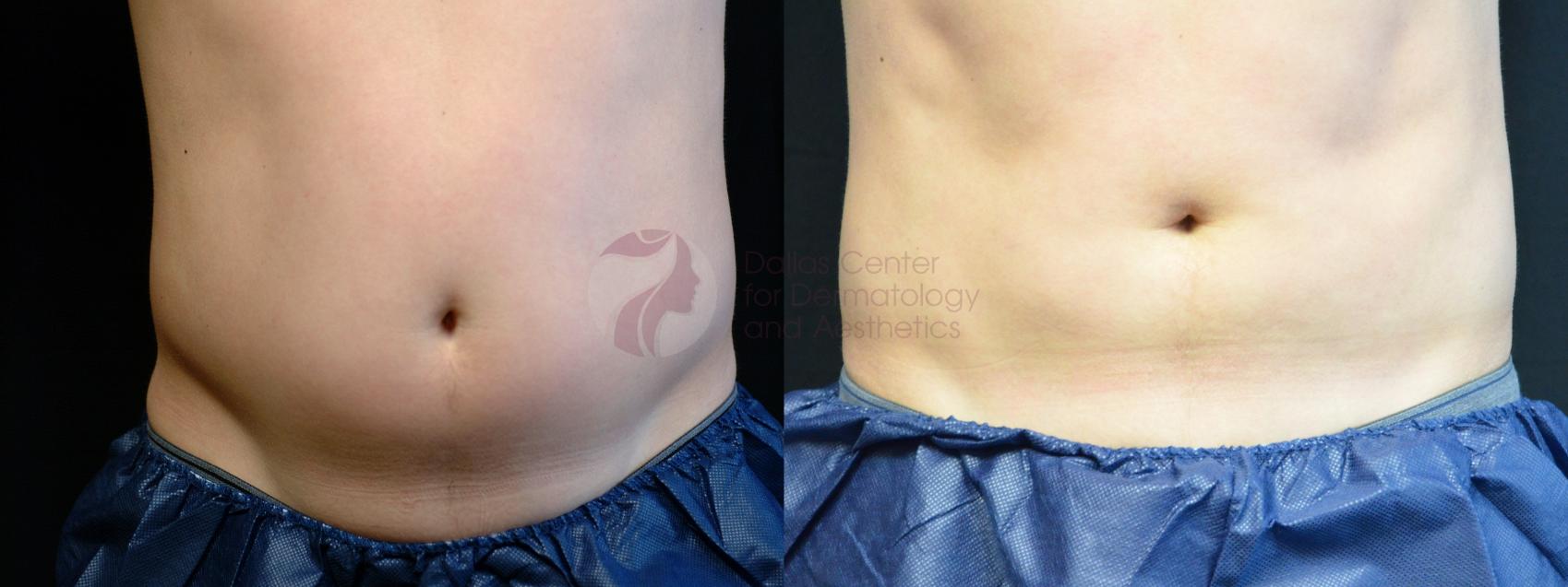 Before & After CoolSculpting® Case 14 Front View in Plano, Frisco, Dallas, Texas