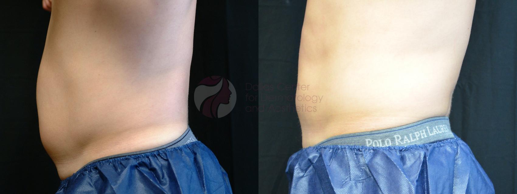 Before & After CoolSculpting® Case 14 Left Side View in Dallas, Plano, and Frisco, TX