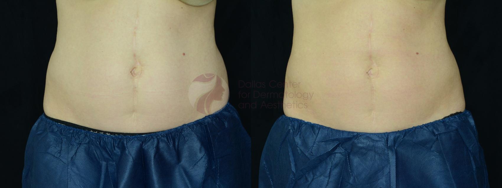 Before & After CoolSculpting® Case 25 Front View in Plano, Frisco, Dallas, Texas