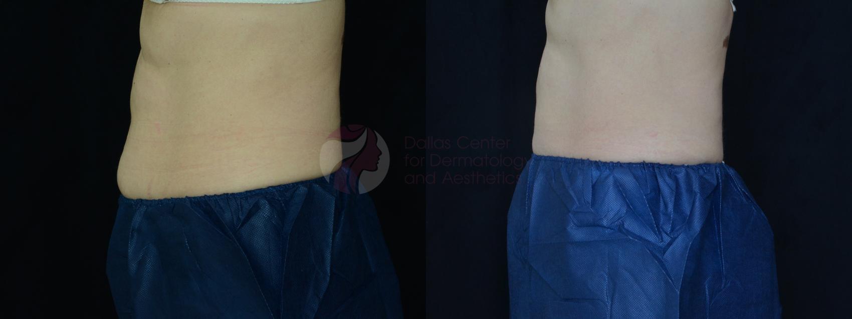 Before & After CoolSculpting® Case 40 Left Side View in Plano, Frisco, Dallas, Texas