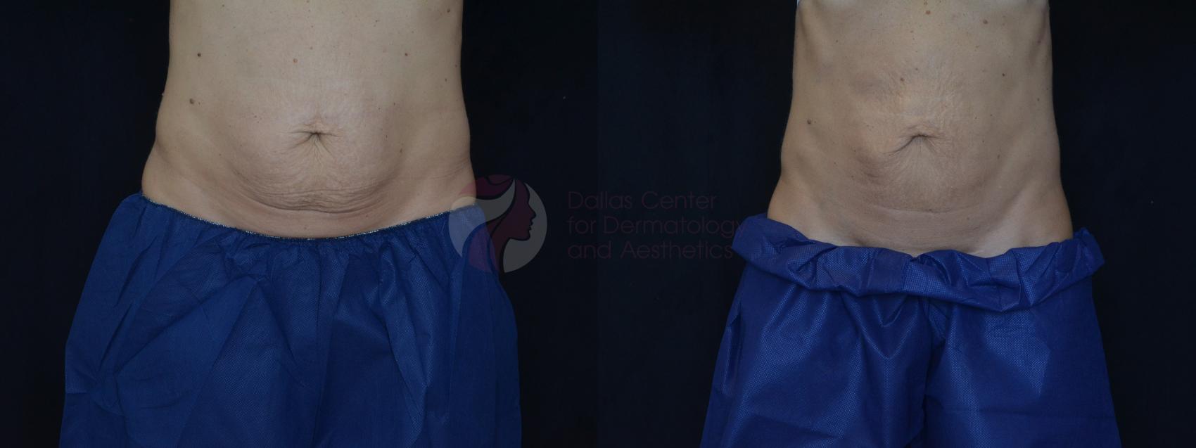 Before & After CoolSculpting® Case 73 Front View in Dallas, TX