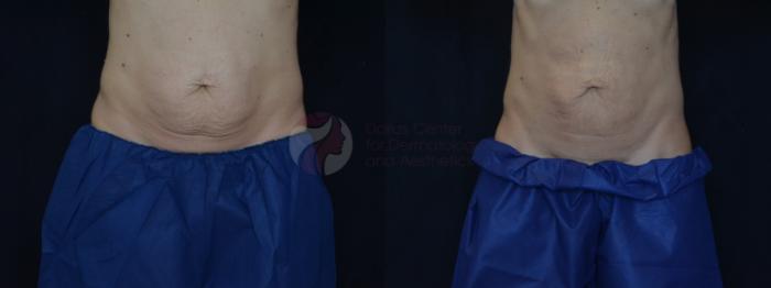 Before & After CoolSculpting® Case 73 Front View in Dallas, TX