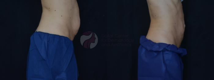 Before & After CoolSculpting® Case 73 Right Side View in Dallas, TX