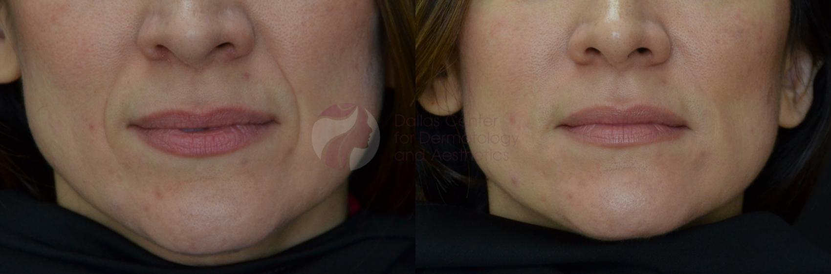 Before & After Dermal Fillers Case 38 View #1 View in Plano, Frisco, Dallas, Texas