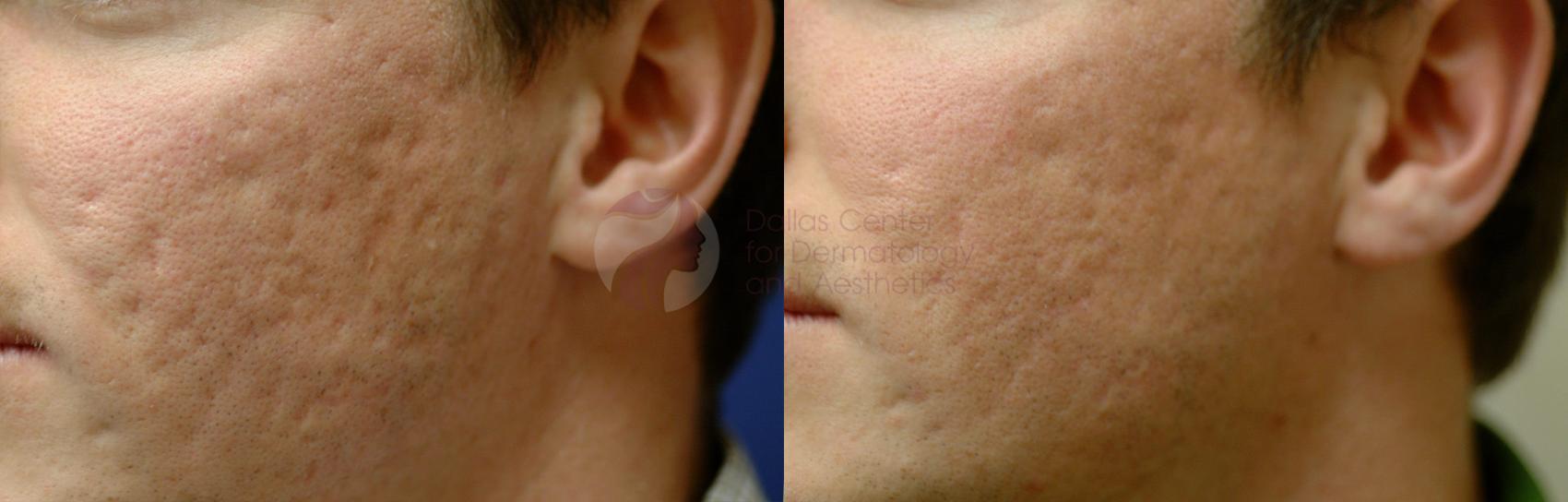 Before & After Fraxel® Skin Resurfacing Case 2 View #1 View in Dallas, TX