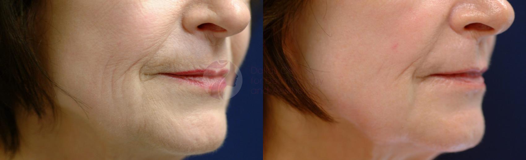Before & After Fraxel® Skin Resurfacing Case 3 View #1 View in Dallas, Plano, and Frisco, TX