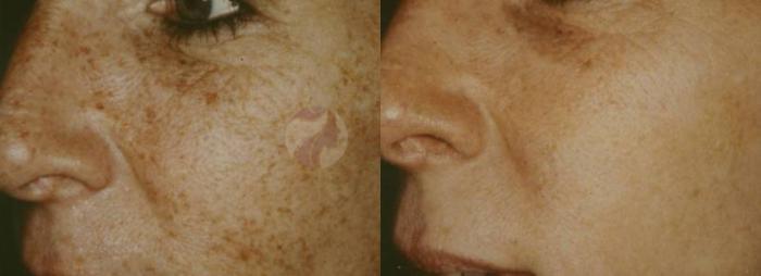 Before & After IPL Photofacial Case 36 View #1 View in Dallas, TX