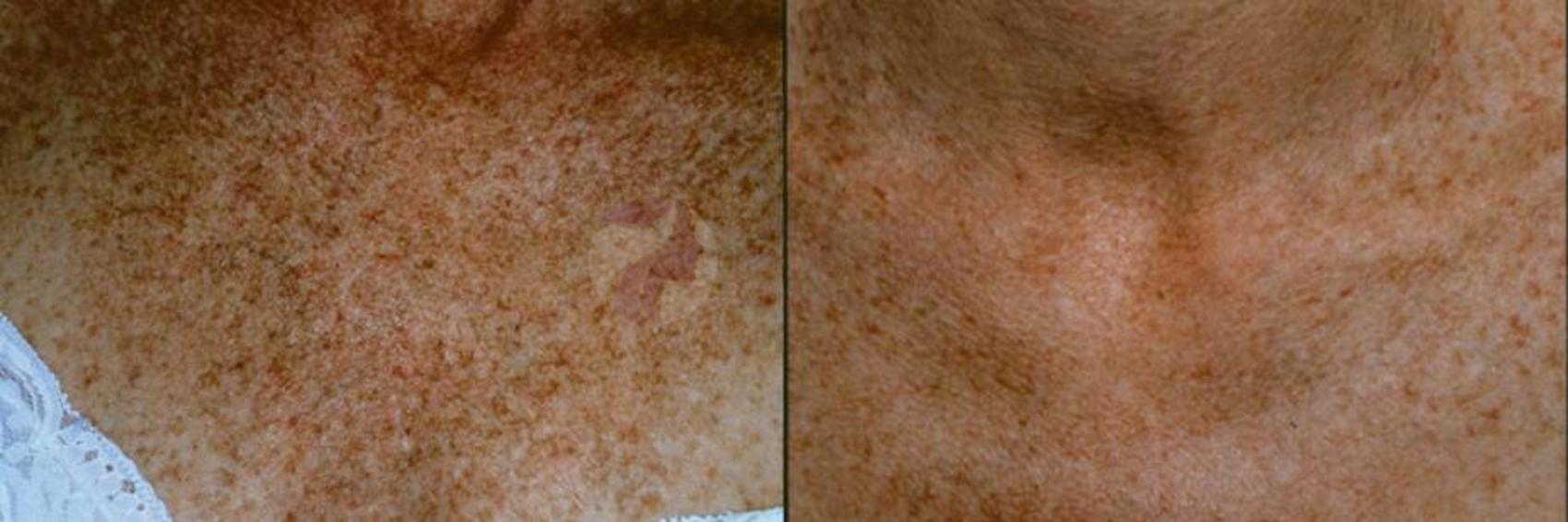 Before & After IPL Photofacial Case 37 View #1 View in Dallas, TX