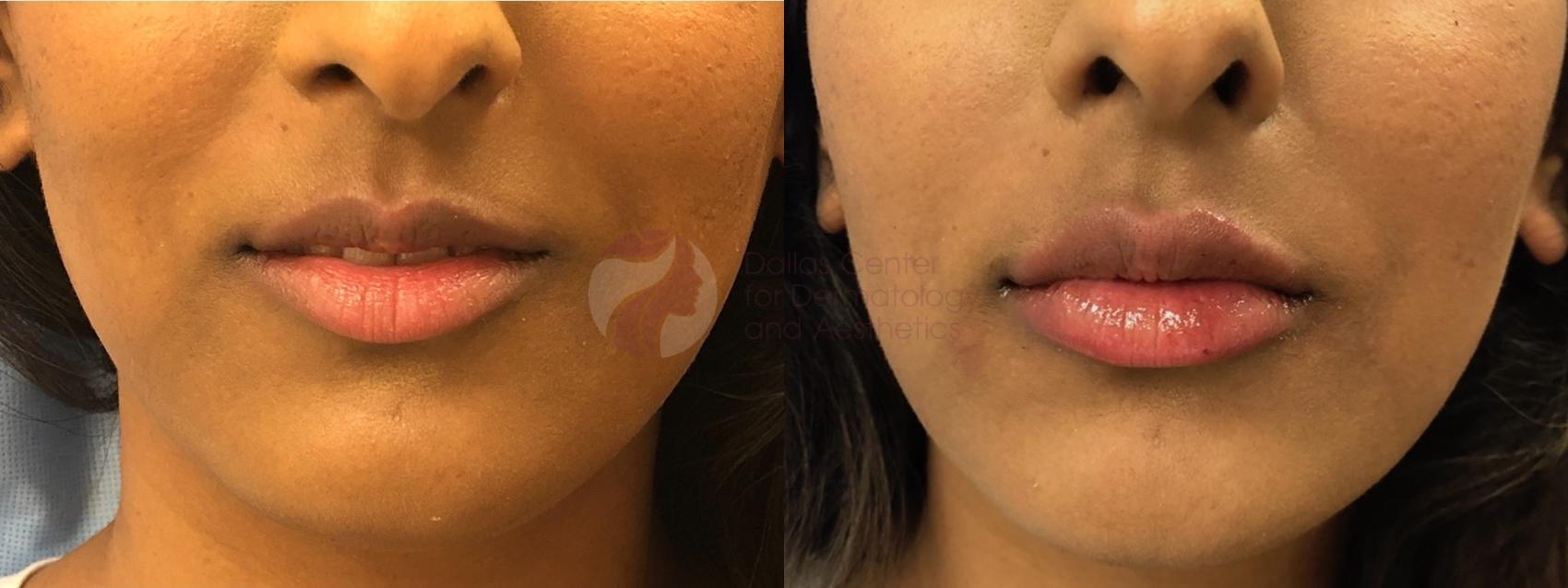 Before & After Dermal Fillers Case 103 Front View in Plano, Frisco, Dallas, Texas