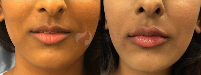 Before & After JUVÉDERM Case 103 Front View in Dallas, TX