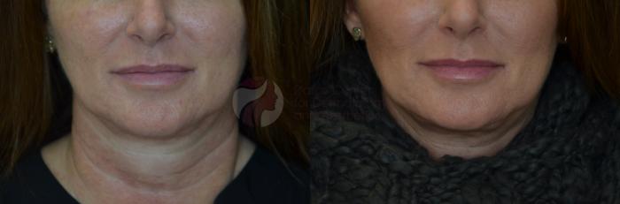 Before & After JUVÉDERM VOBELLA XC Case 81 View #2 View in Dallas, TX