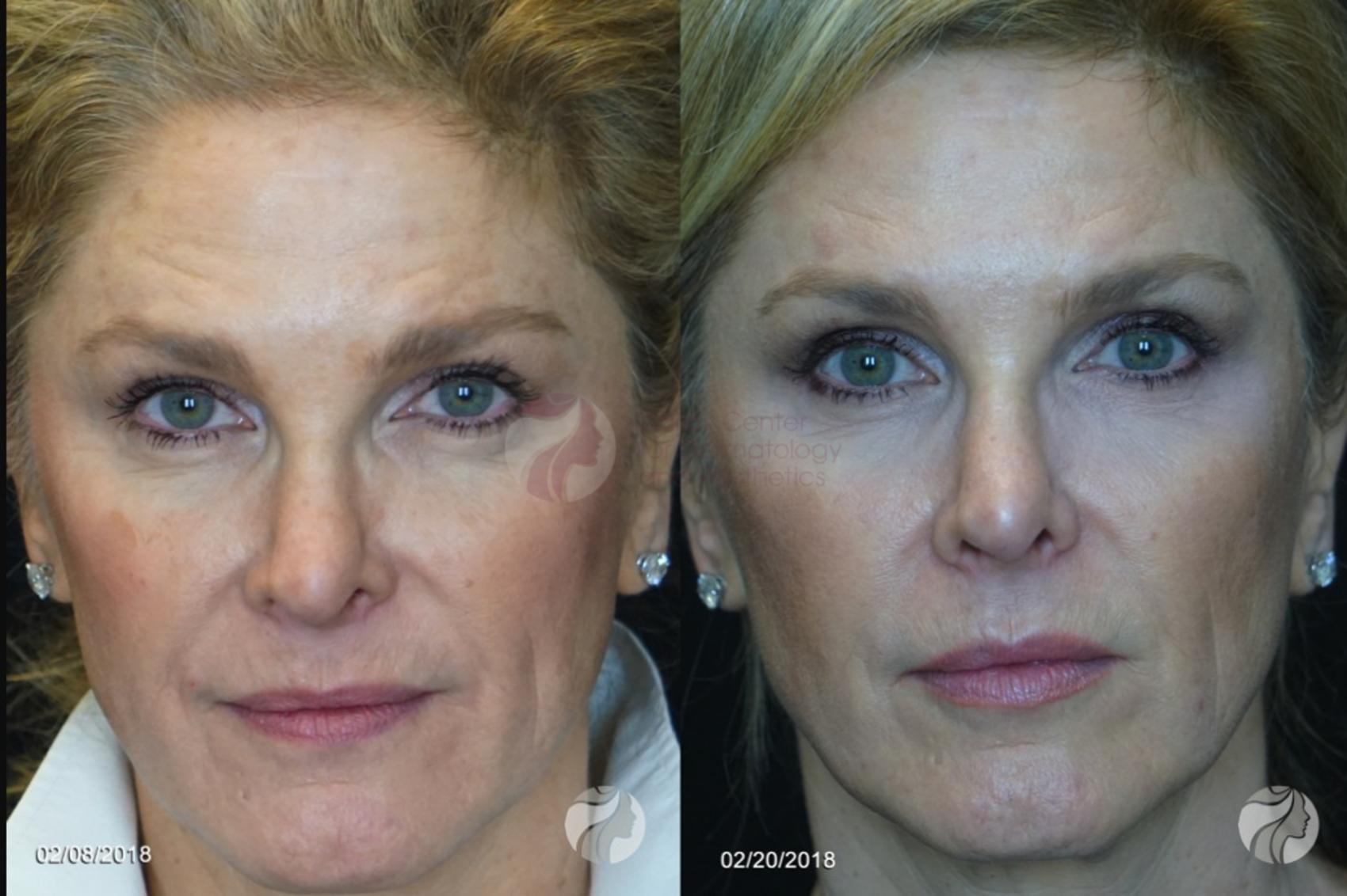 Before & After JUVÉDERM VOBELLA XC Case 86 View #1 View in Plano, Frisco, Dallas, Texas