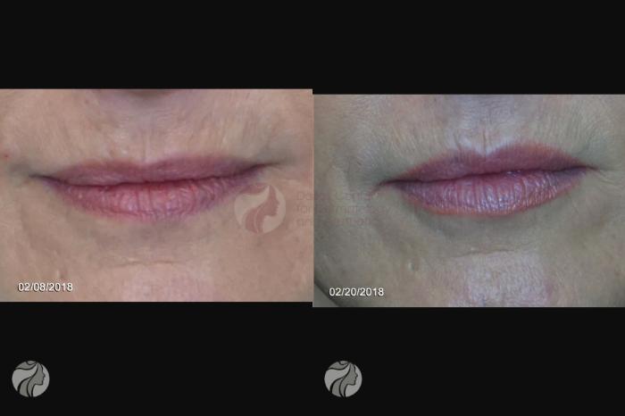Before & After JUVÉDERM VOBELLA XC Case 86 View #2 View in Dallas, TX