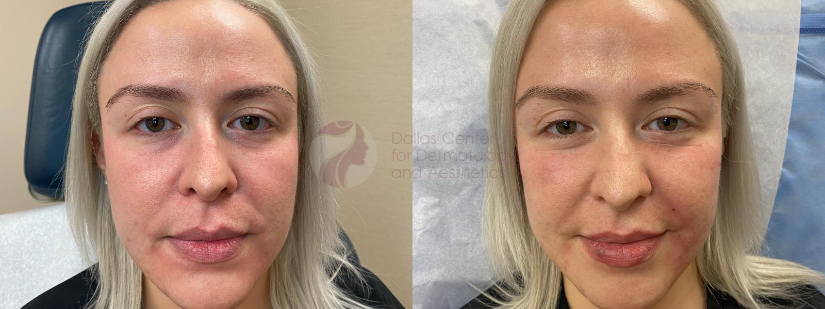 Before & After JUVÉDERM VOLUMA XC Case 106 Front View in Dallas, Plano, and Frisco, TX