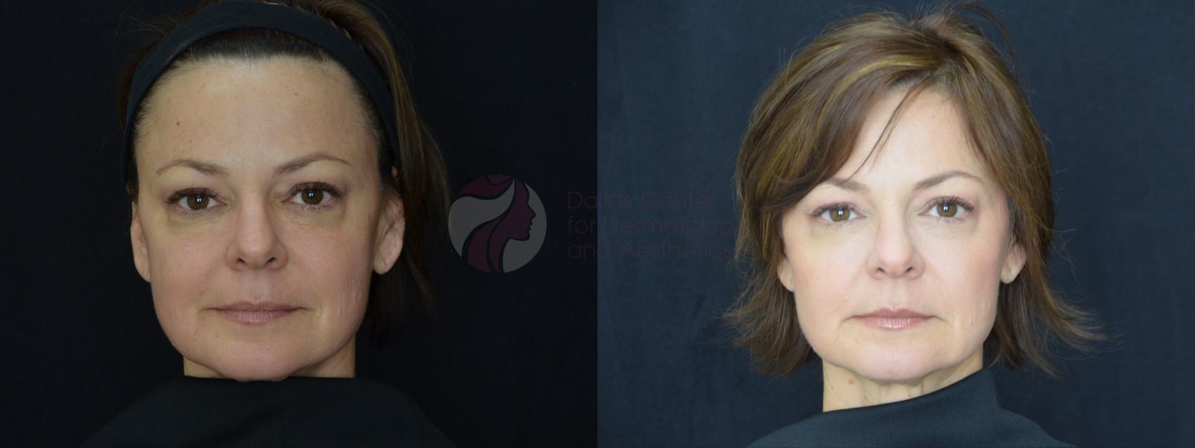 Before & After JUVÉDERM VOLUMA XC Case 48 Front View in Dallas, TX