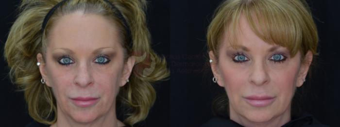 Before & After JUVÉDERM VOLUMA XC Case 51 Front View in Dallas, TX