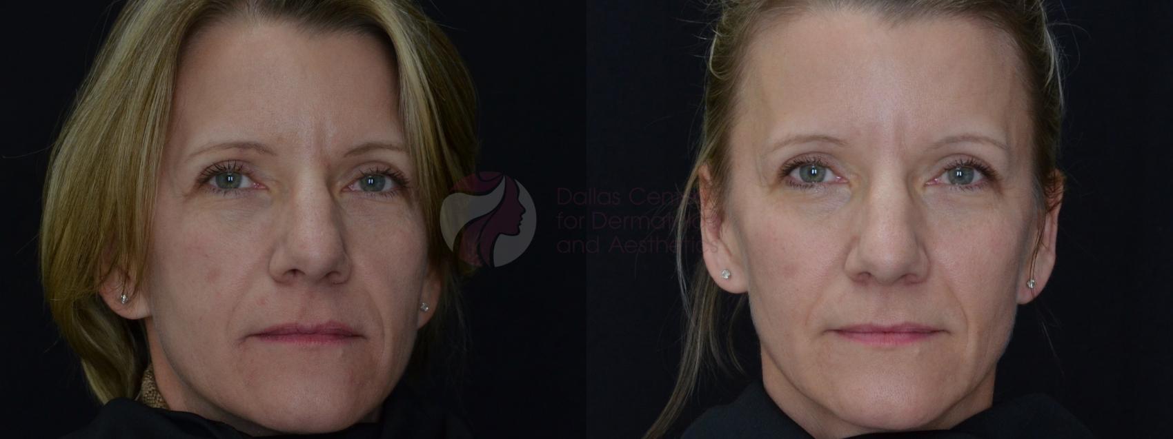 Before & After JUVÉDERM VOLUMA XC Case 53 Front View in Dallas, Plano, and Frisco, TX
