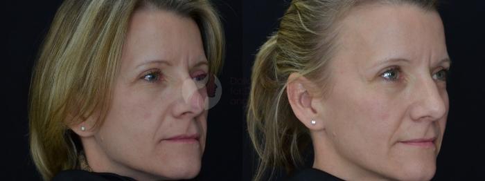 Before & After JUVÉDERM VOLUMA XC Case 53 Right Oblique View in Dallas, TX