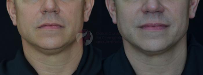 Before & After Kybella™ Case 68 Front View in Dallas, TX