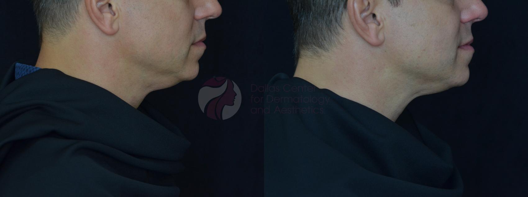 Before & After Kybella™ Case 68 Right Side View in Dallas, TX
