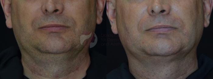 Before & After Kybella™ Case 74 Front View in Dallas, TX