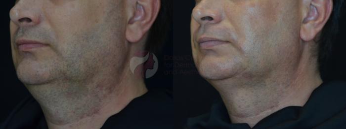 Before & After Kybella™ Case 74 Left Side View in Dallas, TX