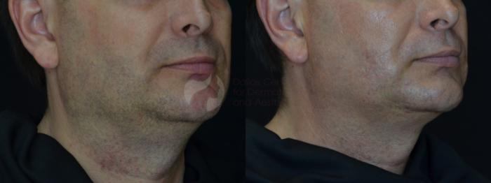Before & After Kybella™ Case 74 Right Side View in Dallas, TX