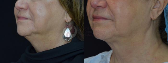 Before & After Kybella™ Case 75 Left Side View in Dallas, TX