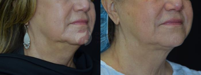 Before & After Kybella™ Case 75 Right Side View in Dallas, TX