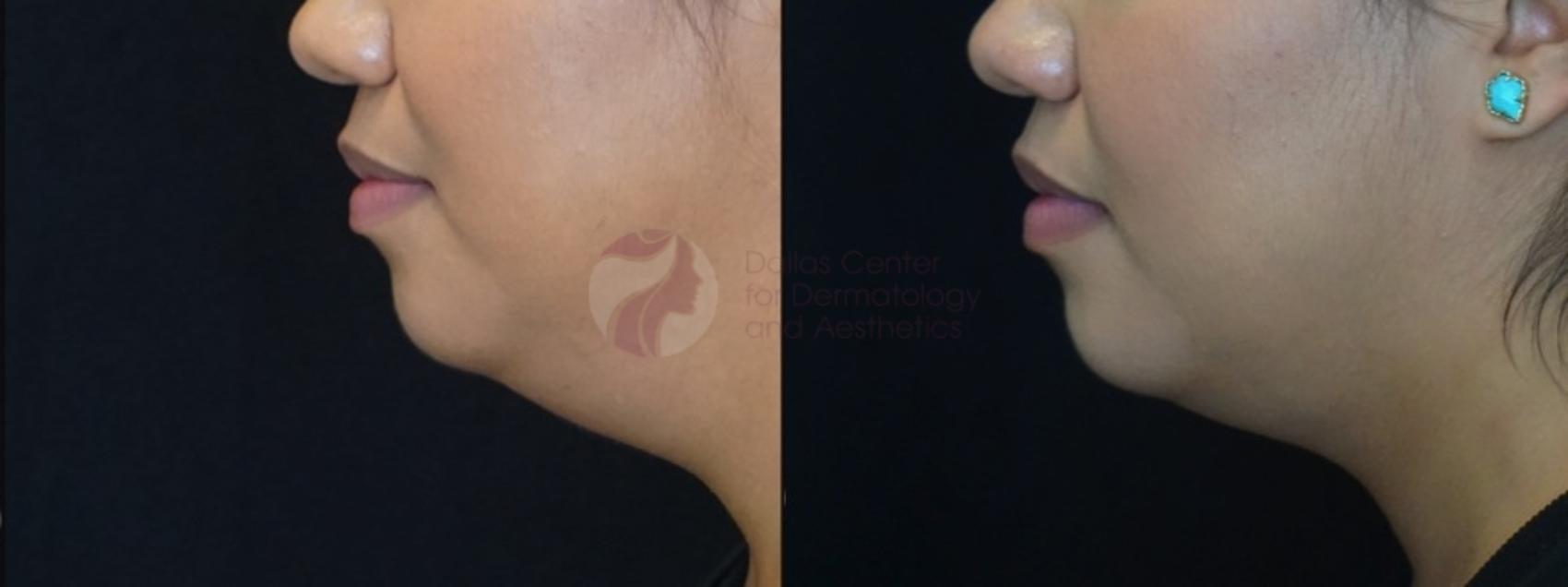Before & After Kybella™ Case 87 Left Side View in Dallas, Plano, and Frisco, TX