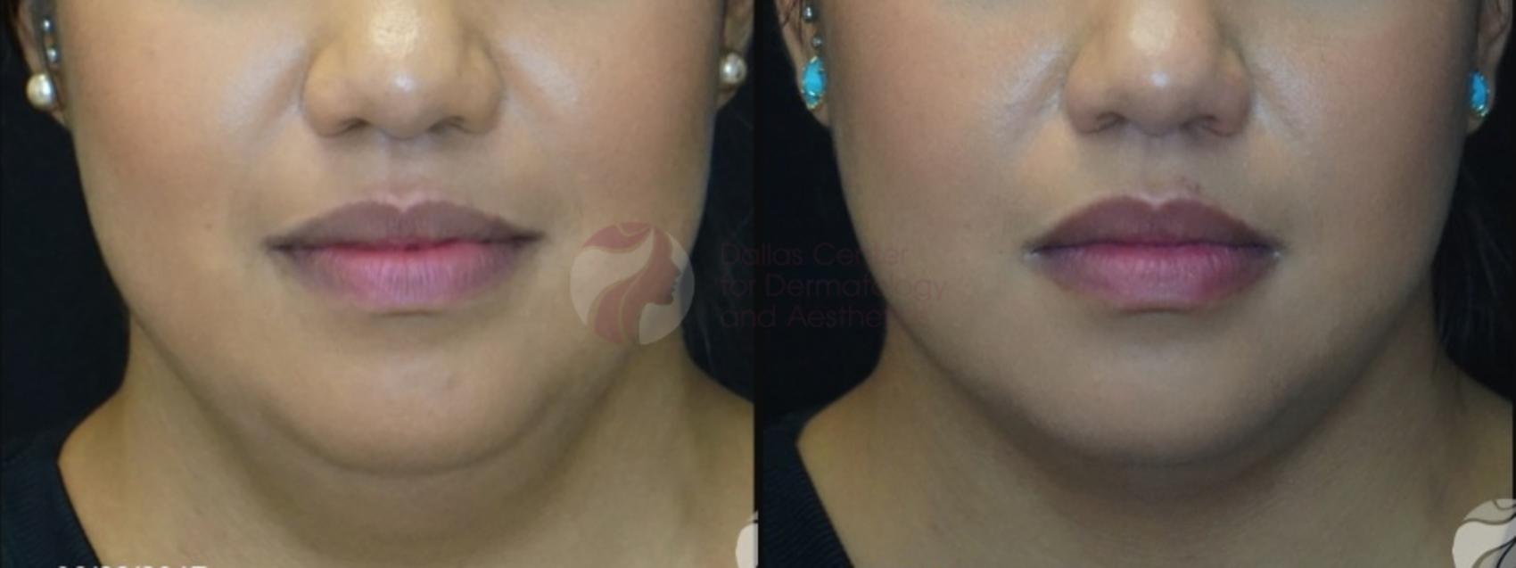 Before & After Kybella™ Case 87 View #1 View in Dallas, TX