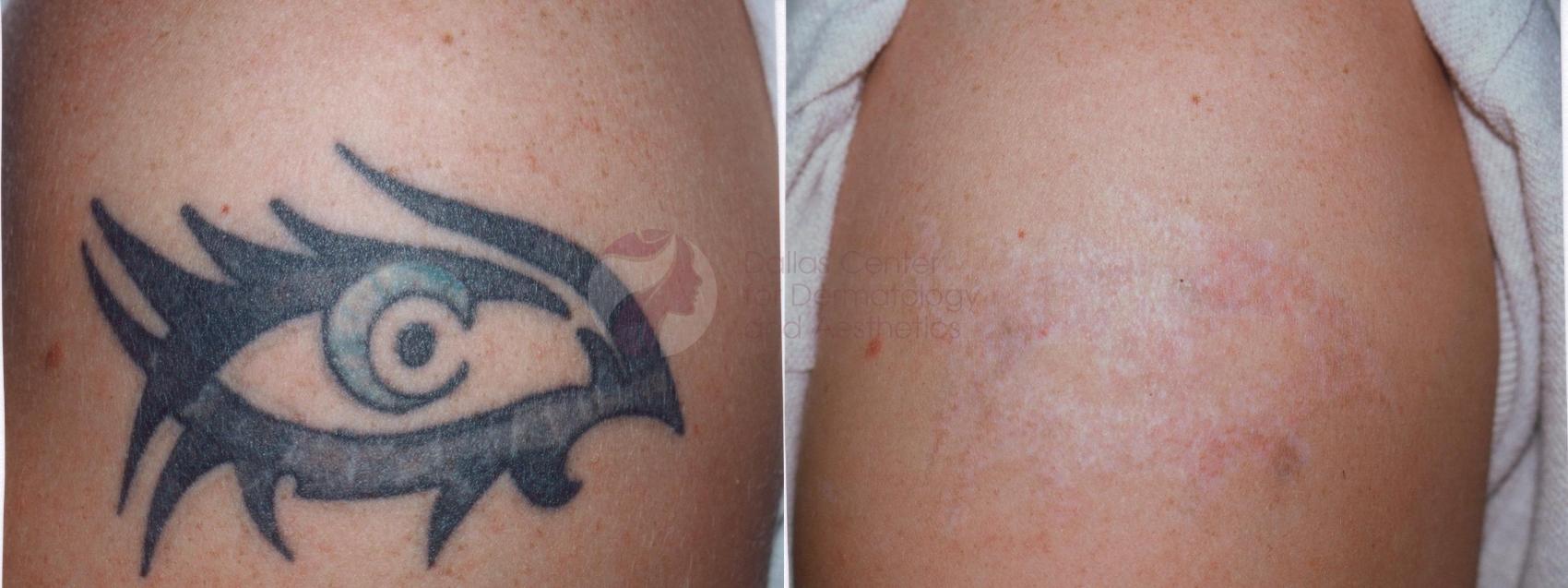 Laser Pigment & Tattoo Removal Before and After Pictures Case 30 | Dallas,  TX | Dallas Center for Dermatology and Aesthetics