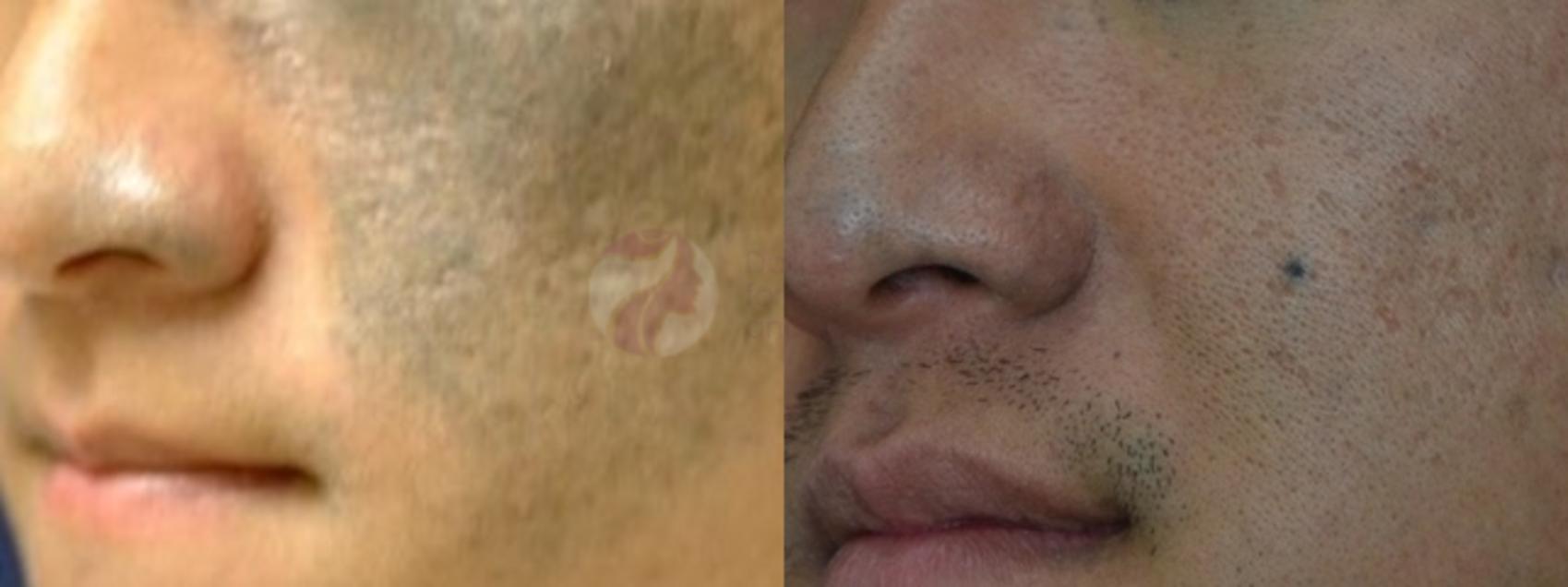 Laser Pigment & Tattoo Removal Before and After Photo Gallery | Dallas, TX  | Dallas Center for Dermatology and Aesthetics