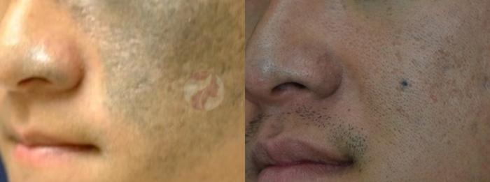 Before & After Laser Pigment & Tattoo Removal Case 65 Left Side View in Dallas, TX