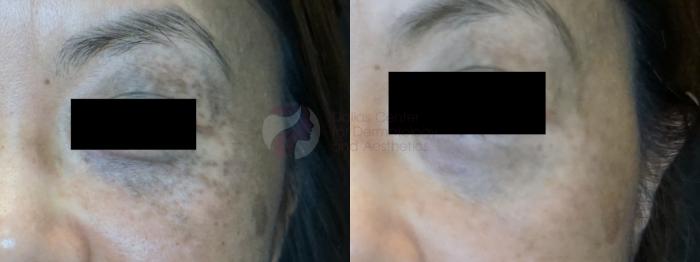 Before & After Laser Pigment & Tattoo Removal Case 91 Front View in Dallas, TX