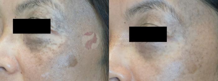 Before & After Laser Pigment & Tattoo Removal Case 91 Left Side View in Dallas, TX