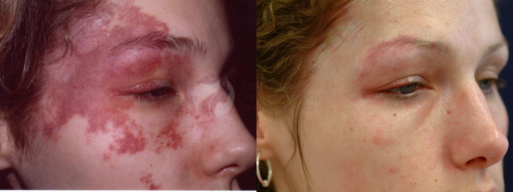 Before & After Pulsed Dye Laser Case 27 Right Side View in Dallas, TX