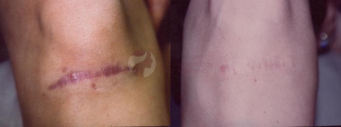 Before & After Pulsed Dye Laser Case 32 Front View in Dallas, TX
