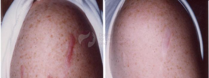 Before & After Pulsed Dye Laser Case 33 Right Side View in Dallas, TX