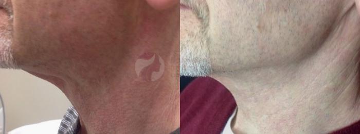 Before & After Pulsed Dye Laser Case 60 Left Side View in Dallas, TX