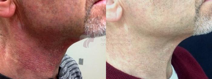 Before & After Pulsed Dye Laser Case 60 Right Side View in Dallas, TX