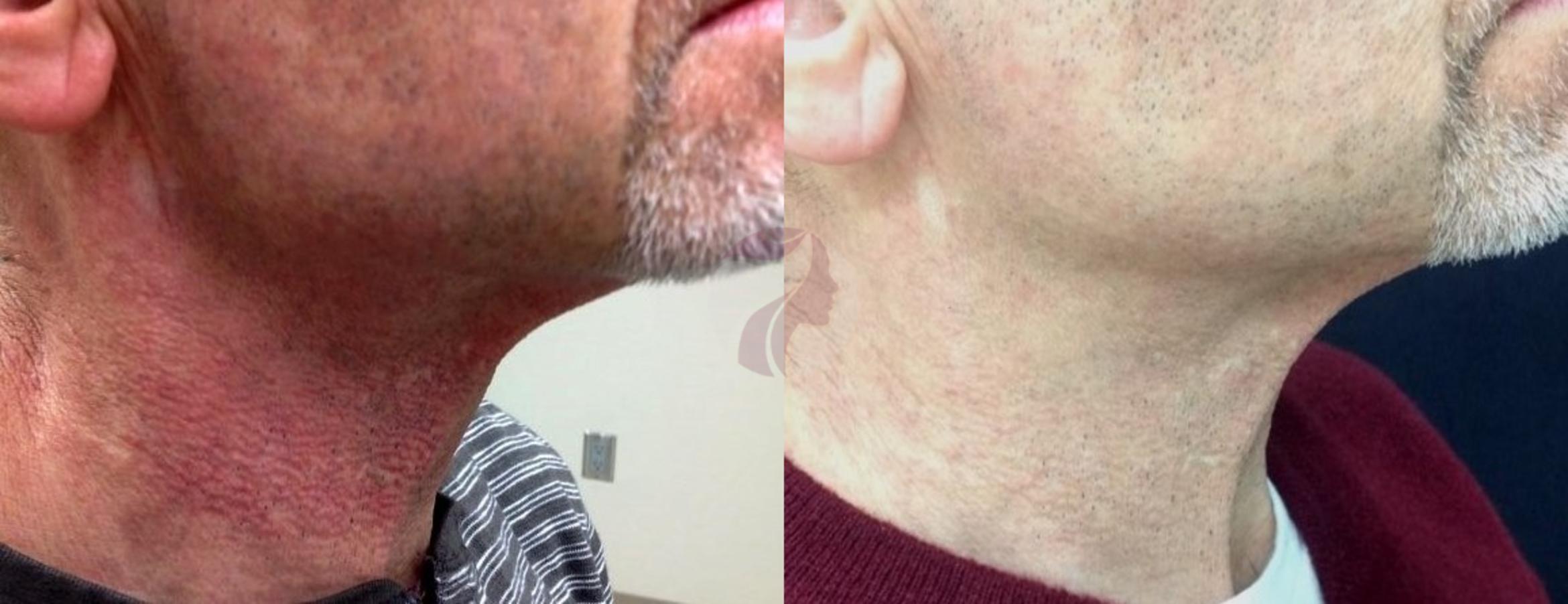 Pulsed Dye Laser Before And After Photo Gallery Dallas Plano And Frisco Tx Dallas Center 