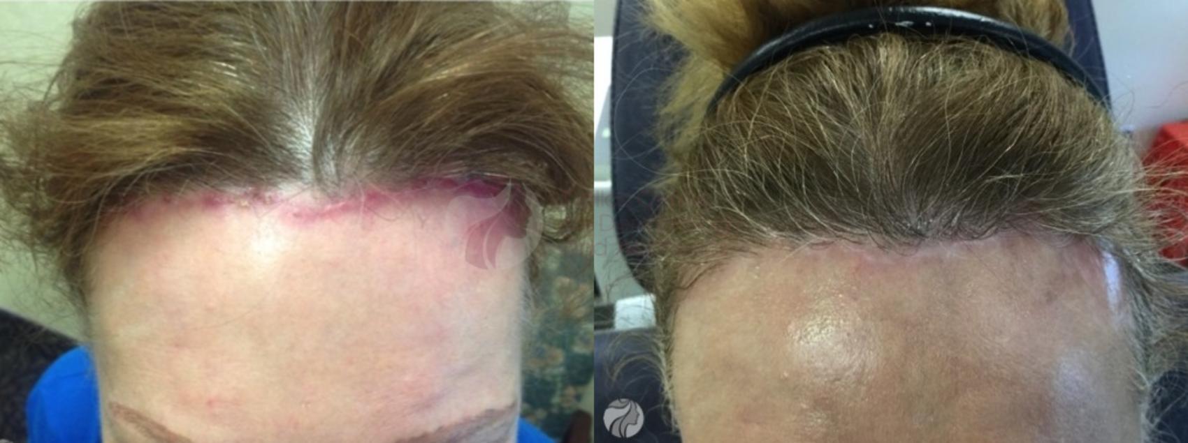 Before & After Pulsed Dye Laser Case 85 Front View in Dallas, TX