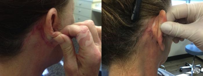 Before & After Pulsed Dye Laser Case 85 Right Side View in Dallas, TX