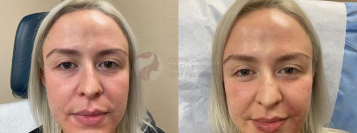 Before and After. Front view of woman's face showing her under eye area before treatment.